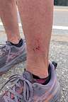 Lone Star Tick Bombing